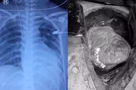 Cứu sống người phụ nữ bị đâm thấu tim, mất hơn 3 lít máu