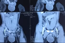 Phát hiện ung thư tinh hoàn nhờ dấu hiệu không ngờ này