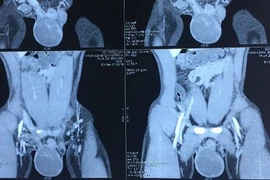 Phát hiện ung thư tinh hoàn nhờ dấu hiệu không ngờ này