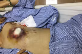 Sự thực về hiệu quả điều trị ung thư vú bằng thuốc nam 