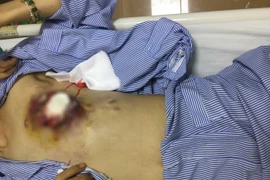 Sự thực về hiệu quả điều trị ung thư vú bằng thuốc nam 