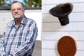 Chuyện lạ: Hắt hơi ra phi tiêu kẹt trong mũi 44 năm 