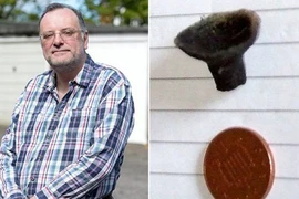 Chuyện lạ: Hắt hơi ra phi tiêu kẹt trong mũi 44 năm 