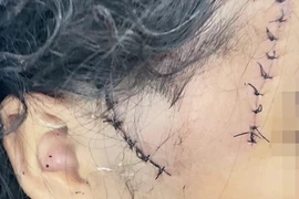 Đồng Nai: Sức khỏe bé gái bị cha dượng gây thương tích đã ổn