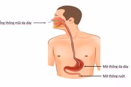 Chuyên gia mách cách chế biến súp cho người bệnh nuôi ăn qua ống thông
