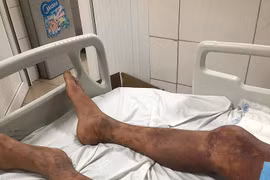 Bác sĩ chỉ rõ đối tượng dễ nhiễm liên cầu khuẩn lợn