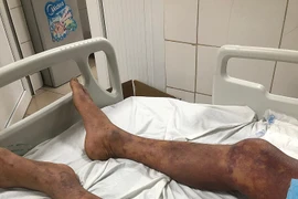 Bác sĩ chỉ rõ đối tượng dễ nhiễm liên cầu khuẩn lợn