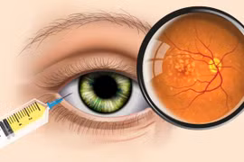 Phương thức điều trị mới cho thoái hóa hoàng điểm do tuổi già