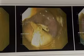 Xương gà 2,5 cm cắm vào thành thực quản tạo ổ áp xe