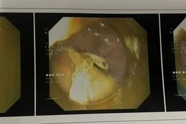 Xương gà 2,5 cm cắm vào thành thực quản tạo ổ áp xe