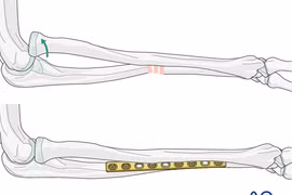 Cẩn thận trẻ liệt thần kinh quay khi ngã chống tay