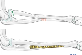 Cẩn thận trẻ liệt thần kinh quay khi ngã chống tay