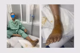 Truyền 10 lọ huyết thanh cứu người bệnh bị rắn lục đuôi đỏ cắn