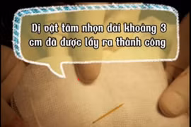 tăm nhọn, thủng ruột, viêm phúc mạc, viêm ruột thừa