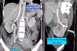 Quá hy hữu: đặt dẫn lưu thận vào tĩnh mạch chủ bụng