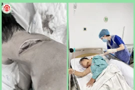 Bệnh nhân bị vi khuẩn ăn thịt người tấn công cổ: Bác sĩ chỉ cách tránh