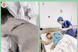 Bệnh nhân bị vi khuẩn ăn thịt người tấn công cổ: Bác sĩ chỉ cách tránh