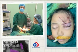 Ngồi chơi trước nhà bé 5 tuổi bị chó cắn rách mặt nặng nề