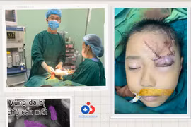 Ngồi chơi trước nhà bé 5 tuổi bị chó cắn rách mặt nặng nề