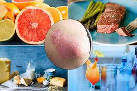 Bệnh nhân vẩy nến nên sử dụng thực phẩm nào?