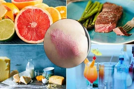 Bệnh nhân vẩy nến nên sử dụng thực phẩm nào?