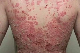 Dinh dưỡng phù hợp kiểm soát và cải thiện bệnh vảy nến