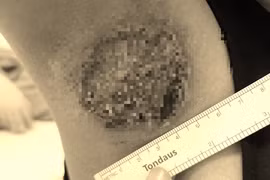 Nách hoại tử, cháy đen vì chữa hôi nách ở Spa