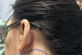 Lấy u tồn tại 8 năm ở vị trí nguy hiểm cho bệnh nhân 18 tuổi