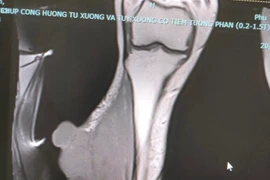 2 lần phẫu thuật u nhỏ như vảy ốc mới phát hiện ung thư di căn