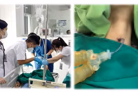 Kẹt tăm bông khi vệ sinh vị trí mở khí quản bệnh nhân nguy kịch