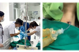 Kẹt tăm bông khi vệ sinh vị trí mở khí quản bệnh nhân nguy kịch