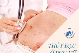 Mang thai cẩn thận tử vong vì thủy đậu