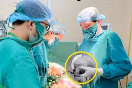 Lấy khối u xơ tử cung kích thước khủng