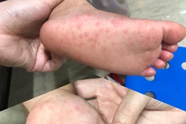 Bác sĩ chỉ cách “né” tay chân miệng cho trẻ