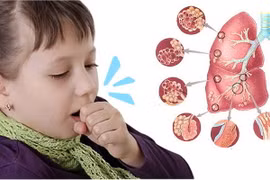 Nguyên nhân ho kéo dài ở trẻ cha mẹ cần biết để chữa kịp thời
