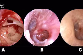 Thủng màng nhĩ do bông ngoáy tai