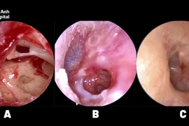 Thủng màng nhĩ do bông ngoáy tai