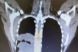 Đau tức bụng nhiều ngày, người đàn ông 43 tuổi phát hiện u trung thất "khủng"