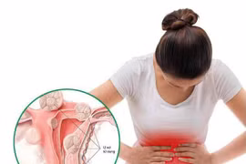 Thiếu nữ 20 tuổi mắc u xơ tử cung do nghiện trà sữa, đồ chiên rán