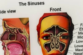  Biến chứng viêm mũi xoang, viêm vòm, viêm họng sau điều trị ung thư