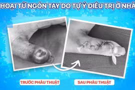 Đắp thuốc lá trị mụn trẻ 14 tuổi bị hoại tử ngón tay