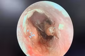 Gián bò vào tai khi đang ngủ, thai phụ suýt thủng màng nhĩ