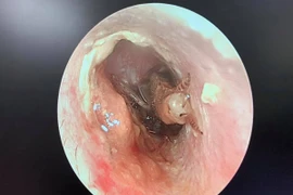 Gián bò vào tai khi đang ngủ, thai phụ suýt thủng màng nhĩ