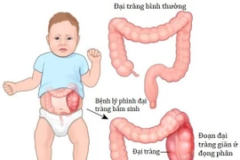 Nhiều trẻ táo bón kéo dài do phình đại tràng cần phải phẫu thuật