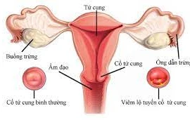 Rỉ máu liên tục vì đốt lộ tuyến không đúng phương pháp