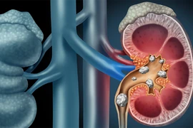 Các dấu hiệu bệnh sỏi thận