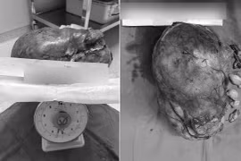 Lấy bỏ khối u 5,5kg “bao trùm” toàn bộ thận trái nam bệnh nhân