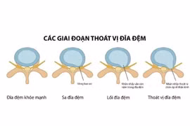 Giải ép thần kinh tránh tàn phế cho người thoát vị địa đệm