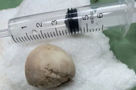 Sặc trứng vịt lộn, thanh niên phải lọc máu vì suy thận