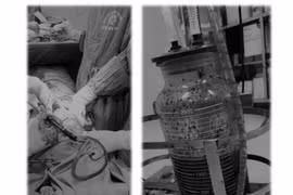 Tiêm thuốc không rõ nguồn gốc trị đau vùng thắt lưng, bệnh nhân nam nguy kịch